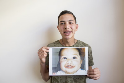 世界牙科聯盟和微笑列車基金會攜手啟動唇齶裂兒童口腔健康改善項目